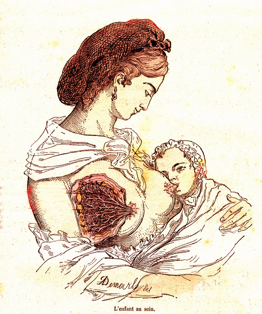 The Child in the Breast (J. Rengade