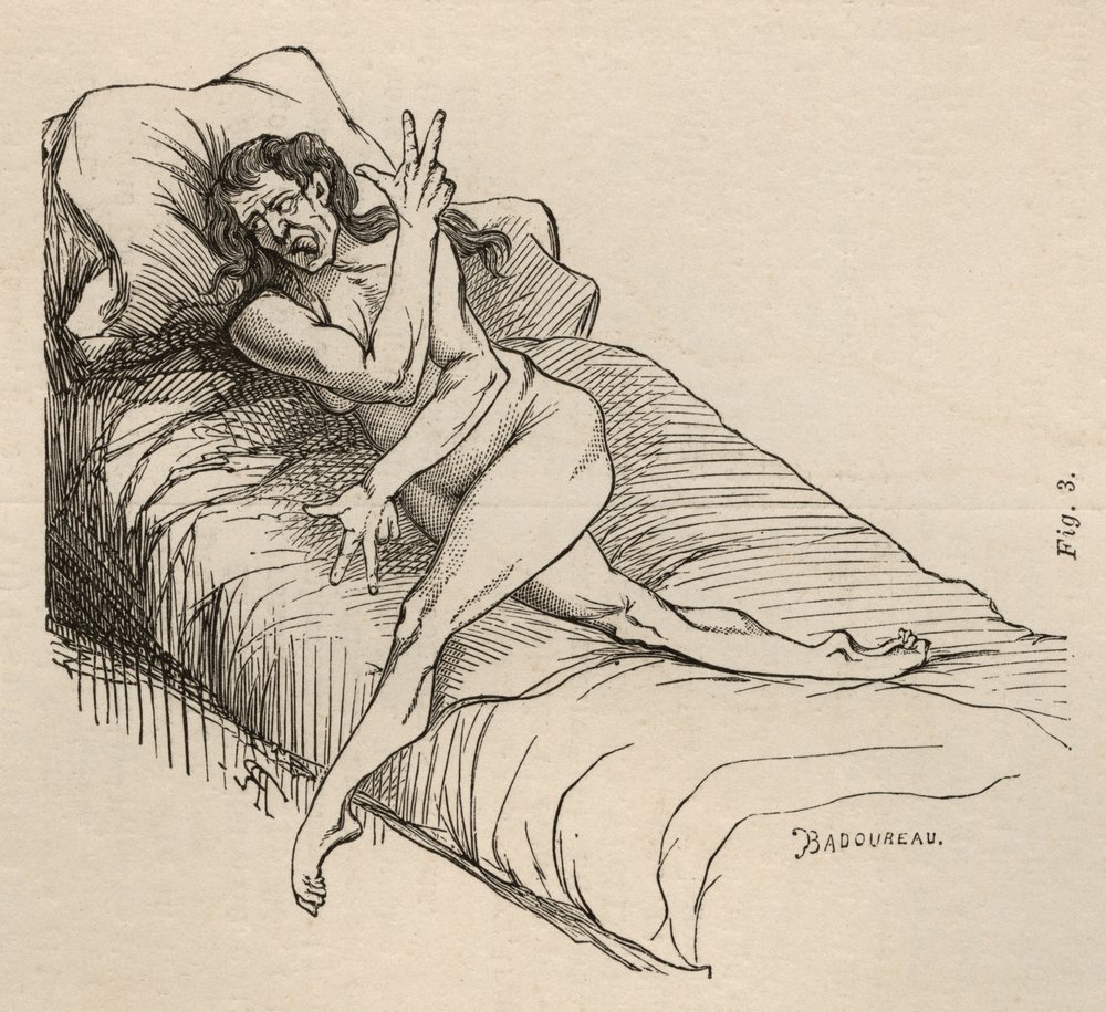 Hysterical epilepsy, attack, contortions, fig. 3 from 'Iconographie ...
