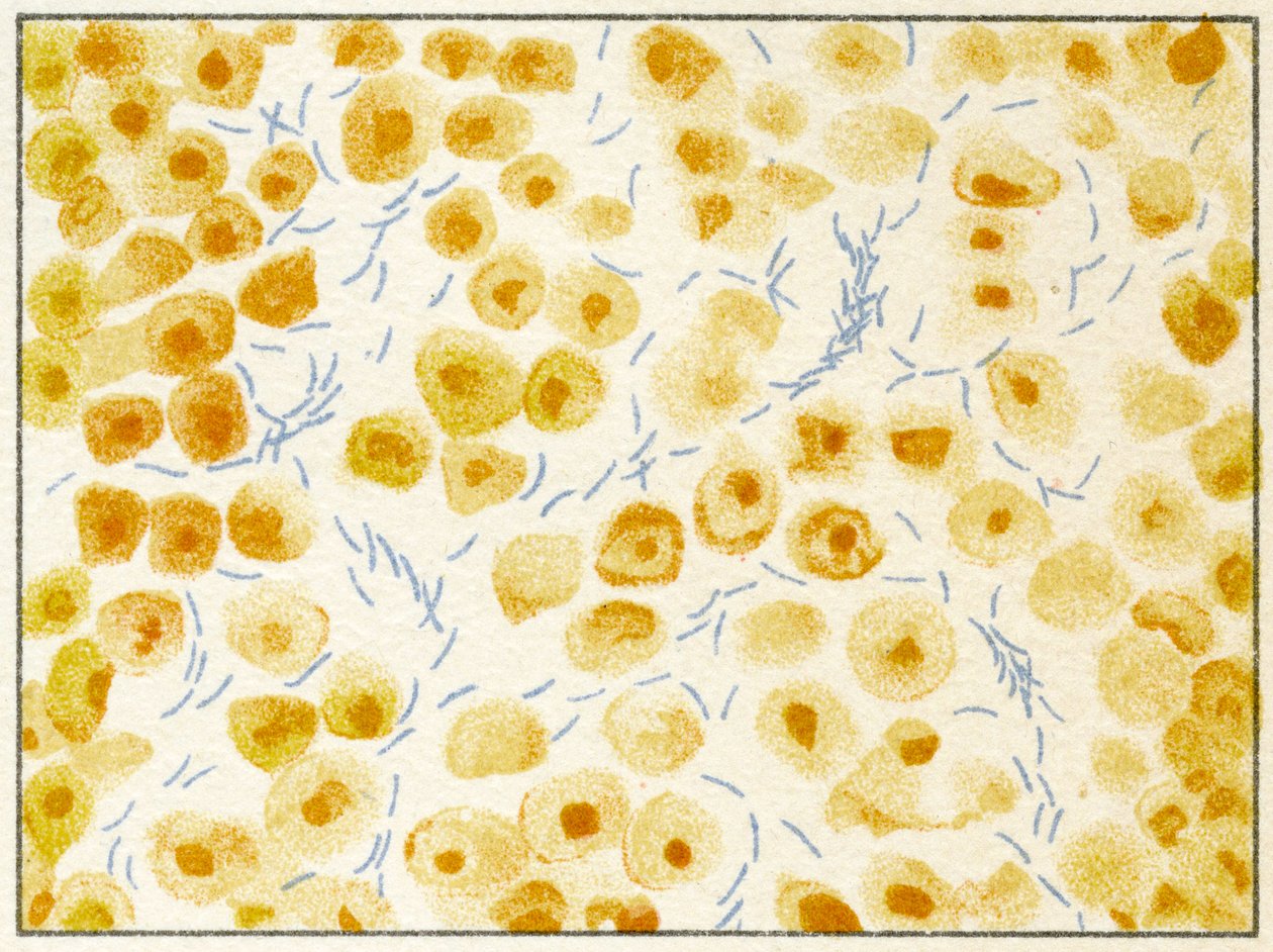 Tuberculosis Bacteria in Sputum by German School