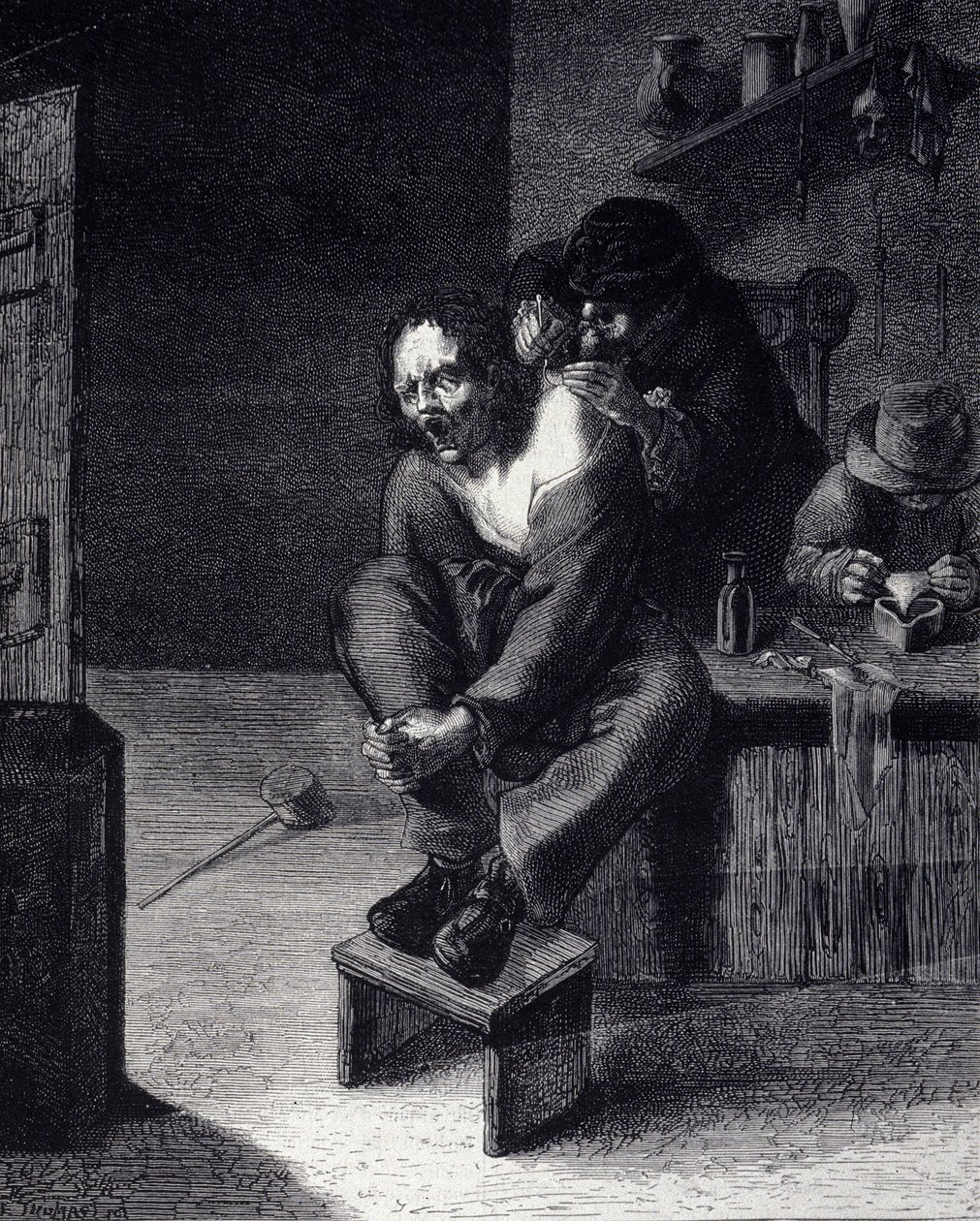 The surgical operation. Engraving after a painting by Adrien Brauwer. 17th century by Adriaen (after) Brouwer