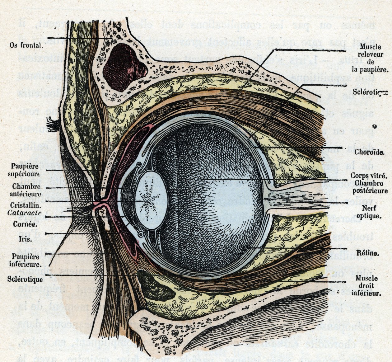 Vertical cut of an eyeball with cataract Engraving from 