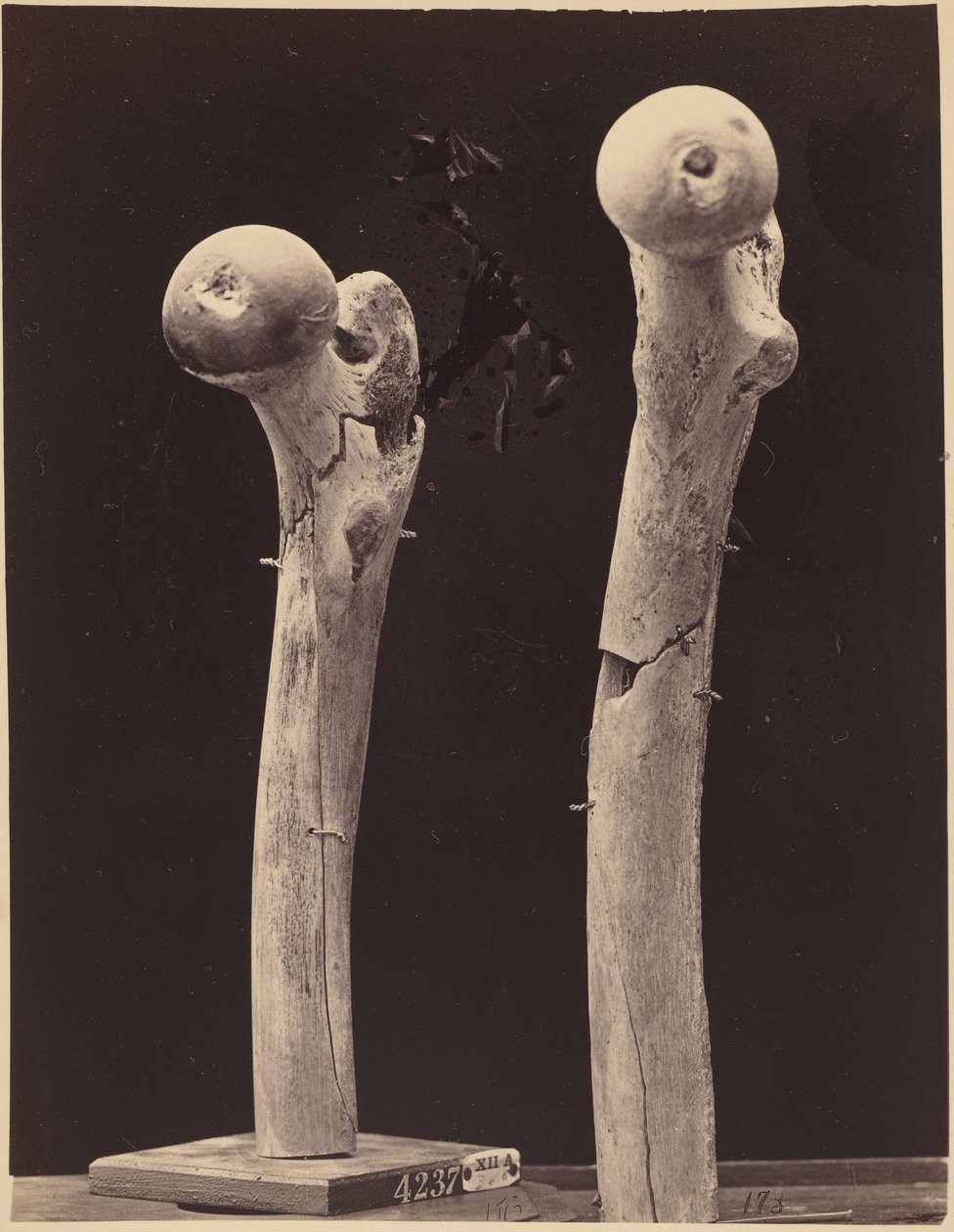 Specimens of Gunshot Fractures of the Femur, c. 1867 by American Photographer