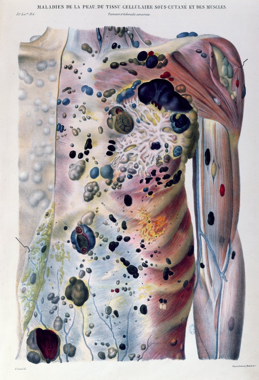 Tumours and cancerous tubercles, from 