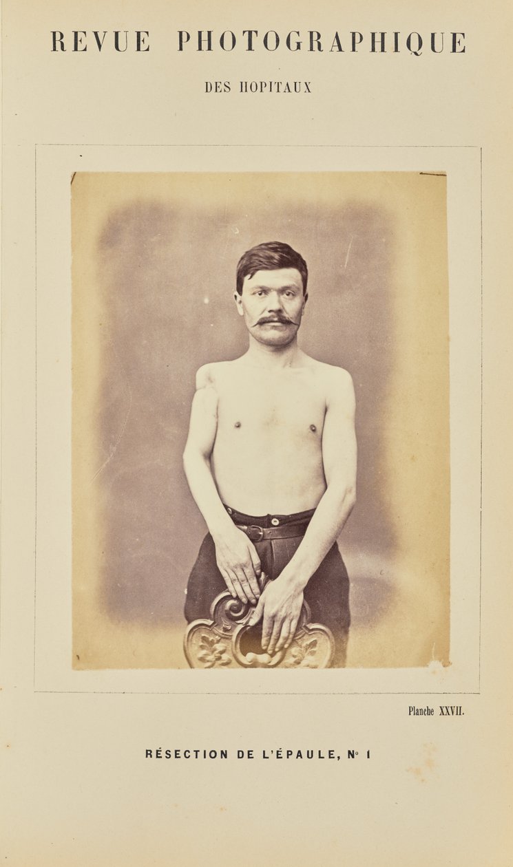 Resection of the Shoulder, Number 1 by Arthur de Montmeja