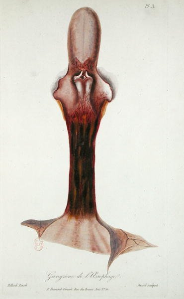 Gangrene of the Oesophagus, from 