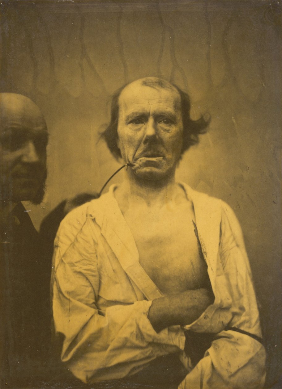 A Relaxed Expression Left, Disgust Right, 1854-1856, printed 1862 by Duchenne de Boulogne