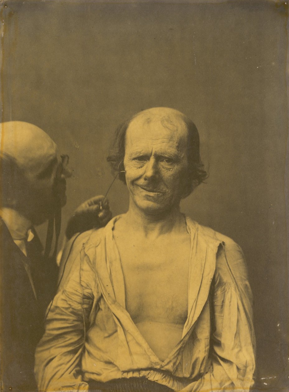 A relaxed face left, False joy or laughter right, 1854-1856, printed 1862 by Duchenne de Boulogne