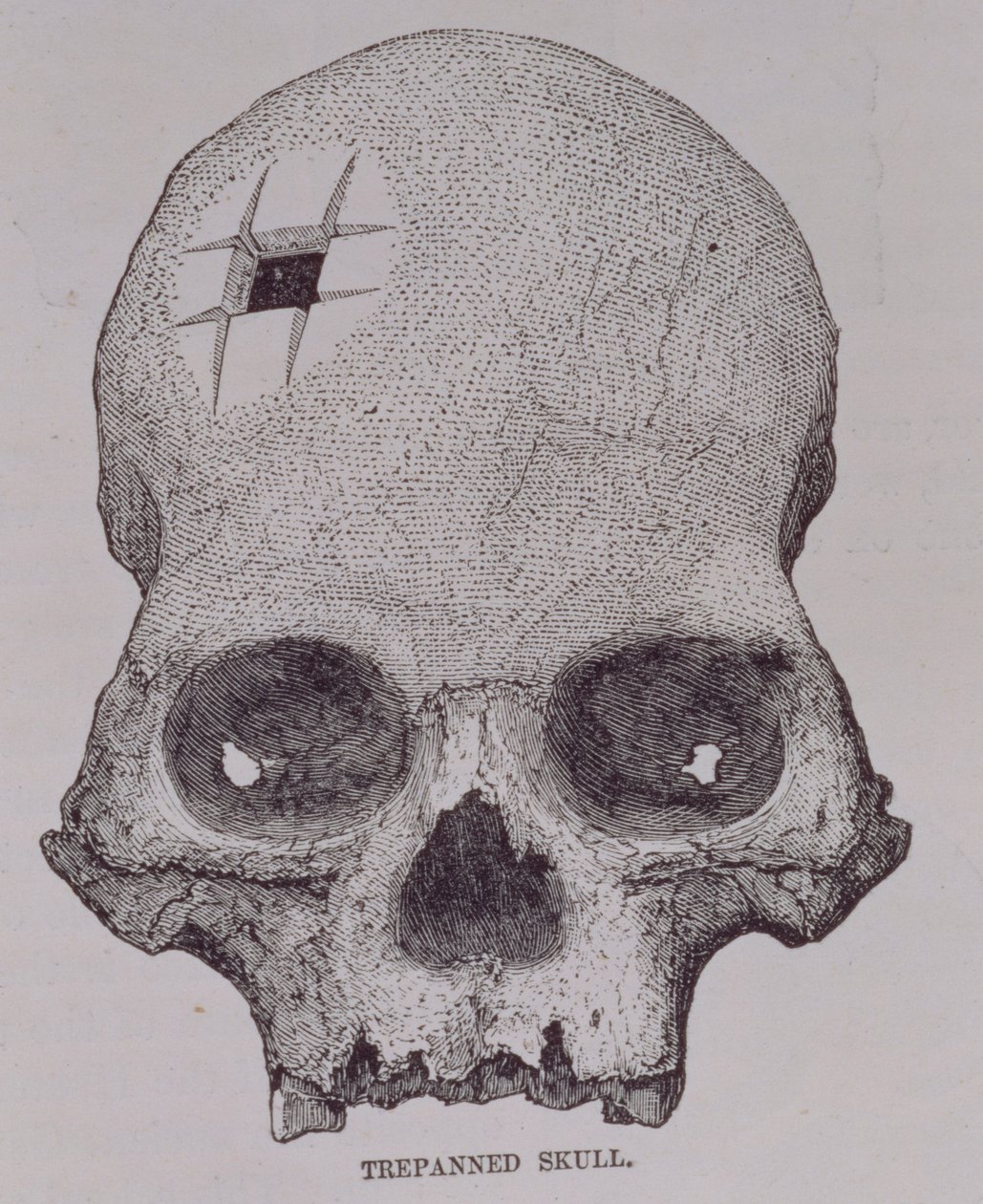 Trepanned Skull, from 