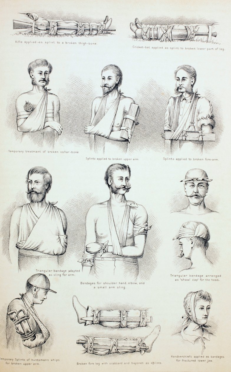 Temporary Treatment of Fractures by English School
