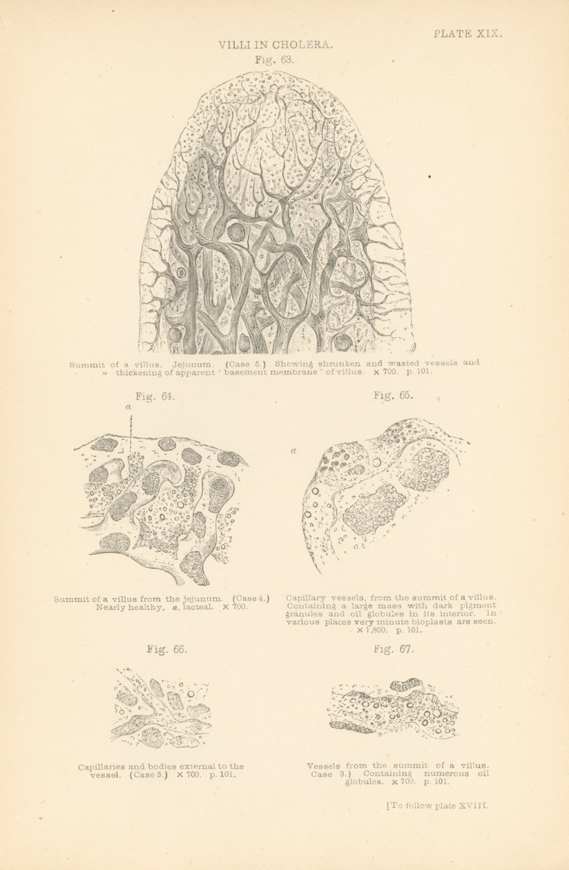 Villi in Cholera by English School