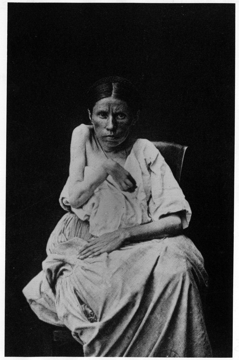 Photograph of a patient suffering from hemiplegic epilepsy, in 