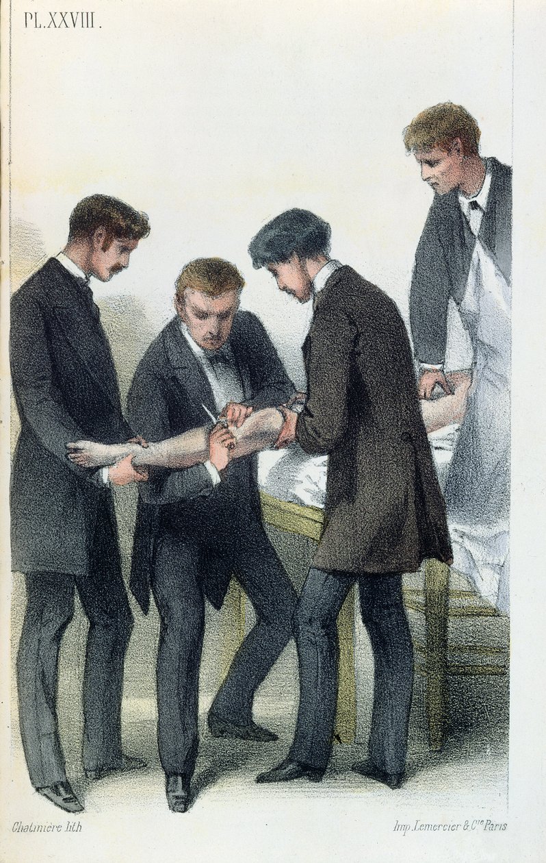 Amputating an arm, from a medical manual by Jean-Baptiste-Leon Dubreuil by French School