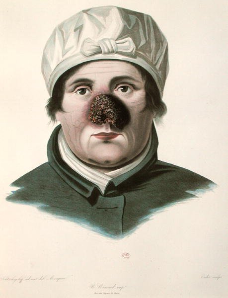 Before a skin graft operation, from 