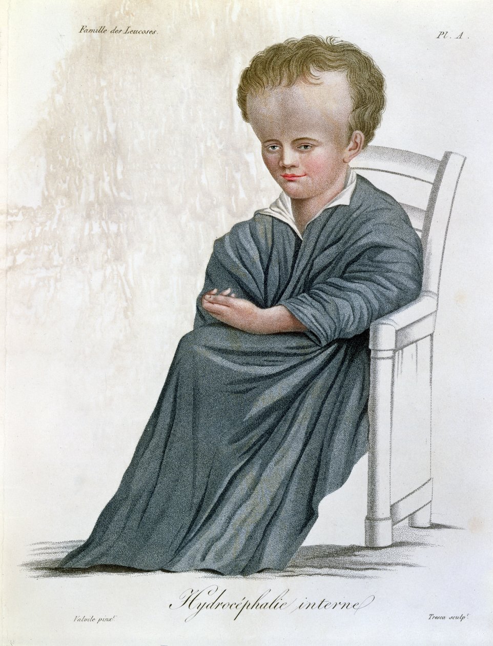 Internal Hydrocephalus, from Nosologie Naturelle by Baron Jean Louis Alibert engraved by Tresca by French School