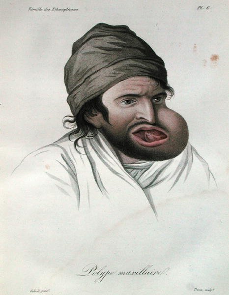 Maxillary polyp, from a book by Baron Jean Louis Alibert by French School