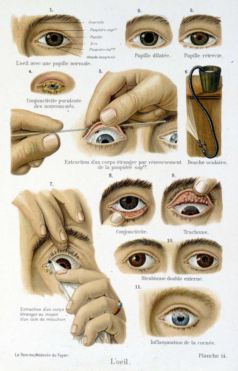 Medicine: the eye by French School