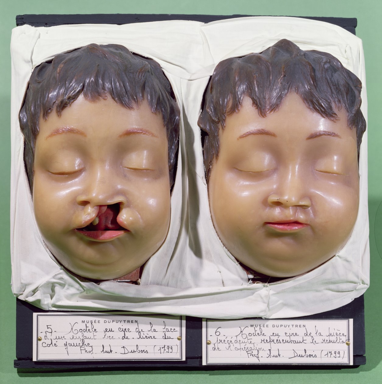 Model showing a child's face before and after an operation to correct a ...