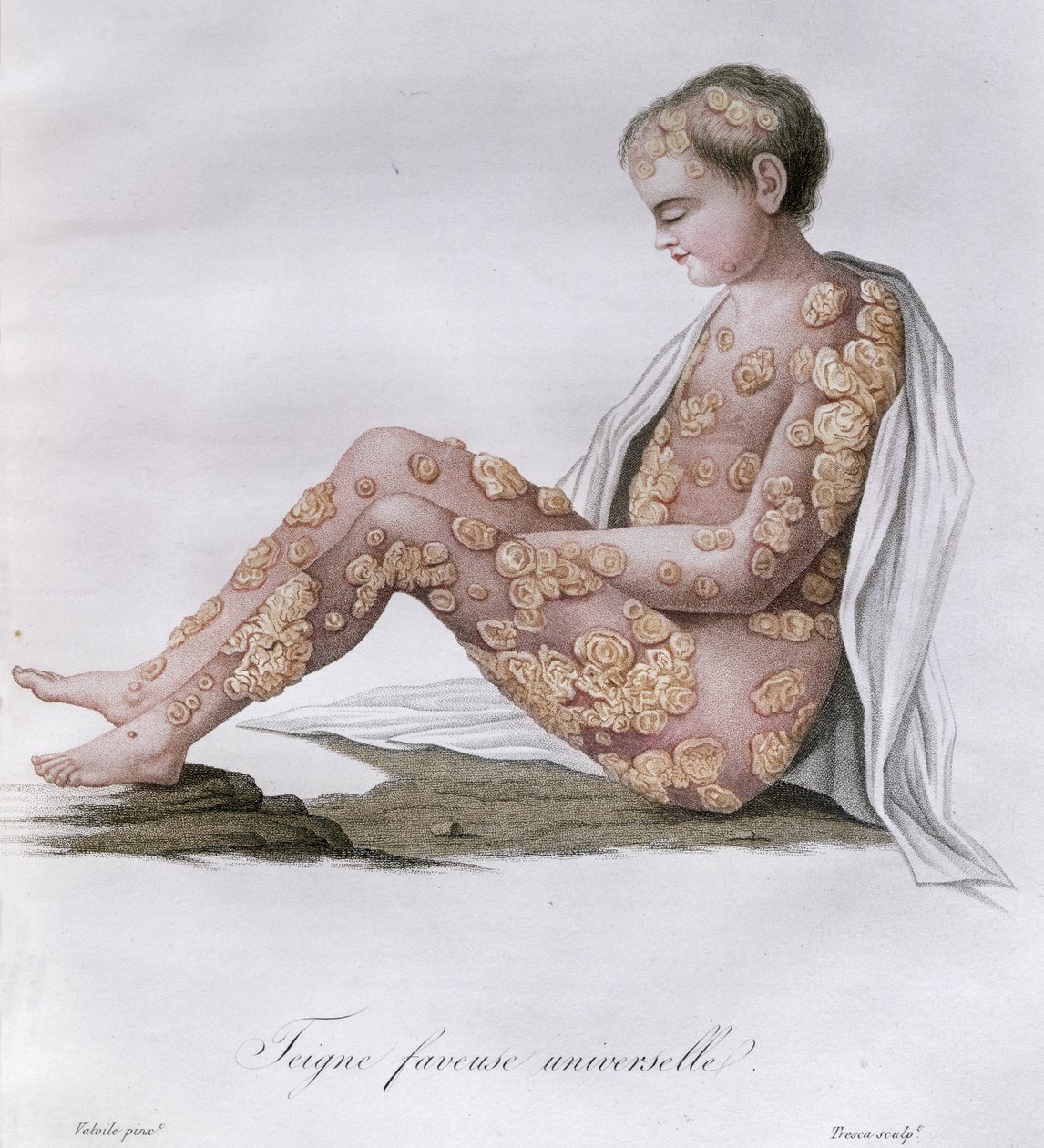 Ringworm, from a Book by Baron Jean Louis Alibert, 1838 by French School