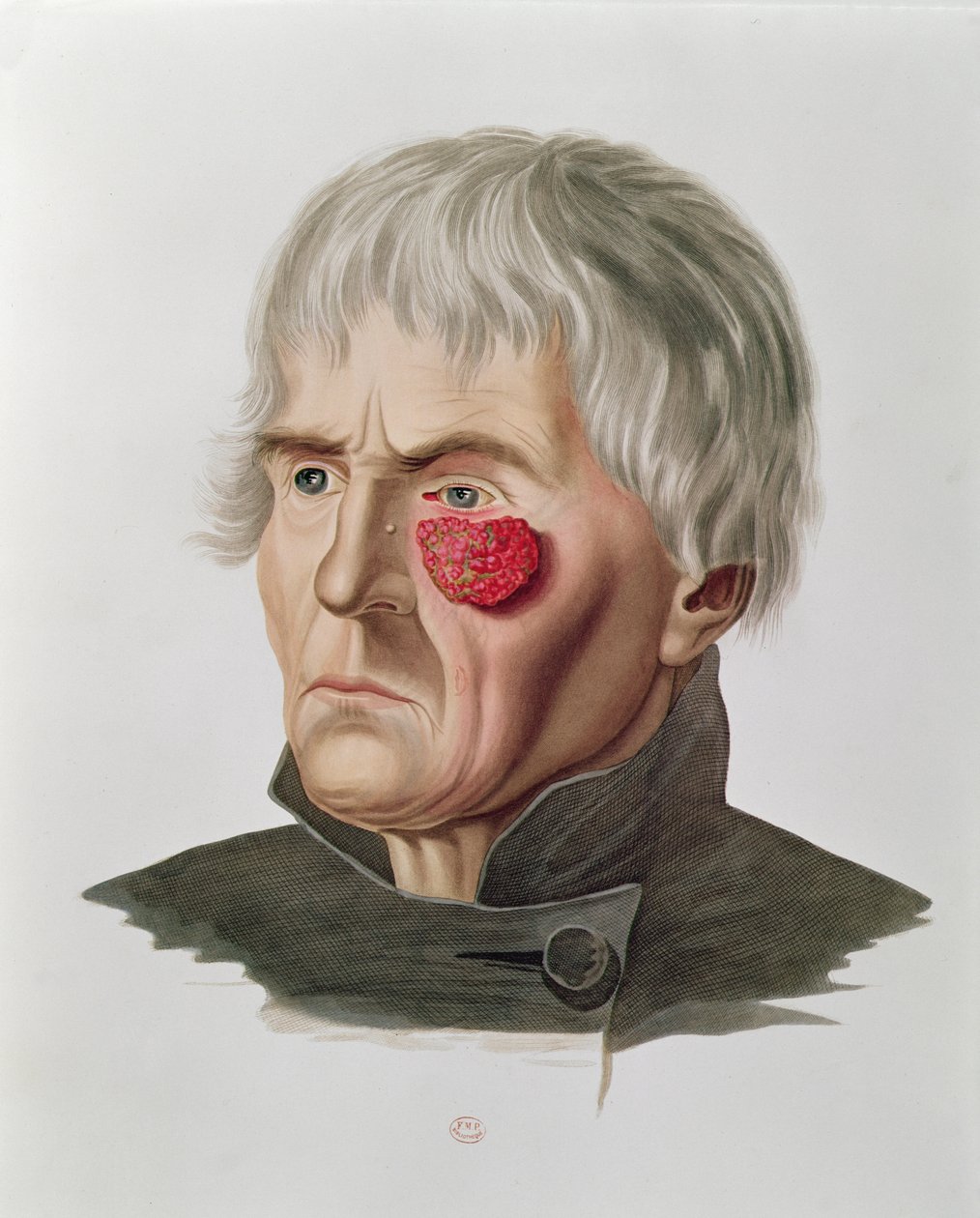 Skin Disease Before an Operation, from Selecta Praxis Medico-Chirurgica by Alexander Auvert by French School