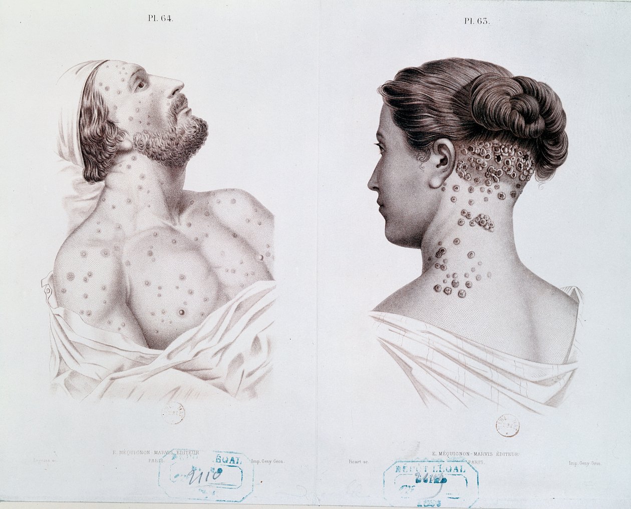 Symptoms of syphilis in men and women, from a medical book by French School