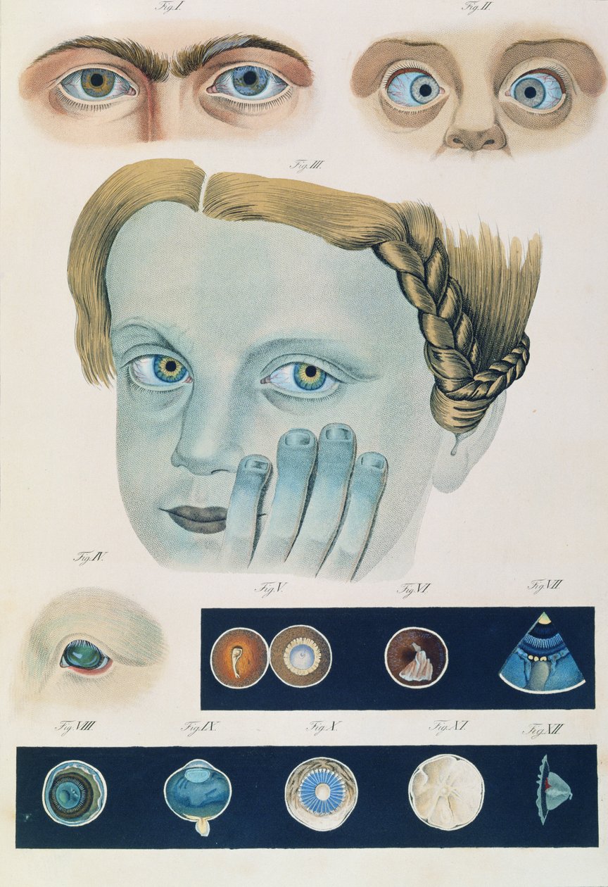 Description of congenital eye anomalies, from Klinische Darstellungen der Krankheiten und Blidungsfehler des Menschlichen Auges, by Friedrich August von Ammon, 1838 by German School