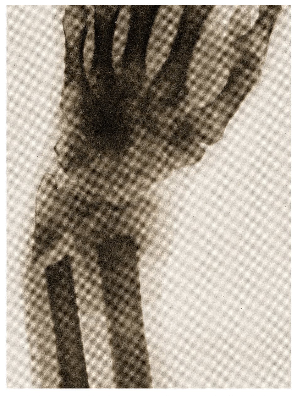 X Ray of a Fractured Wrist by German School