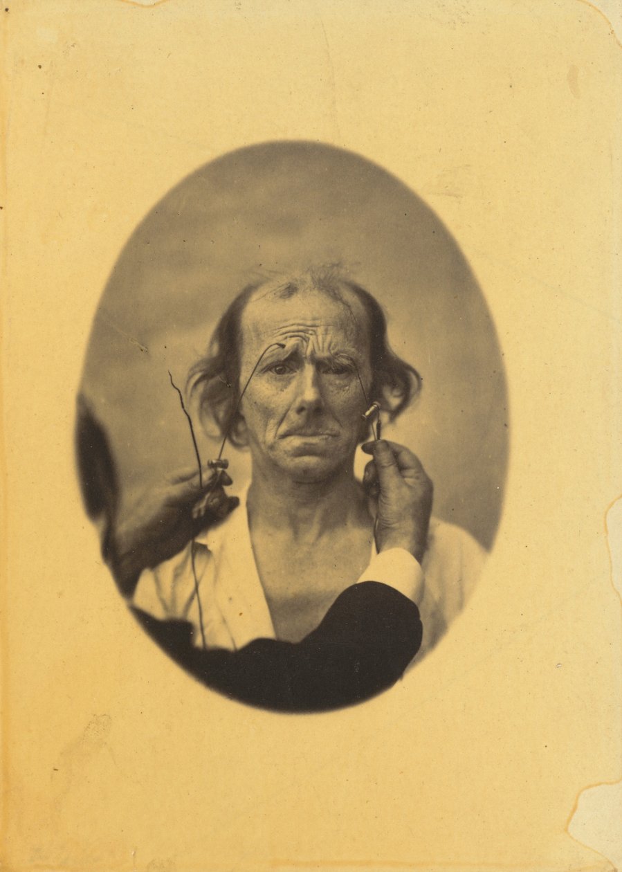 Dissatisfaction, somber thoughts (left); Reflection (right) by Guillaume Benjamin Armand Duchenne de Boulogne