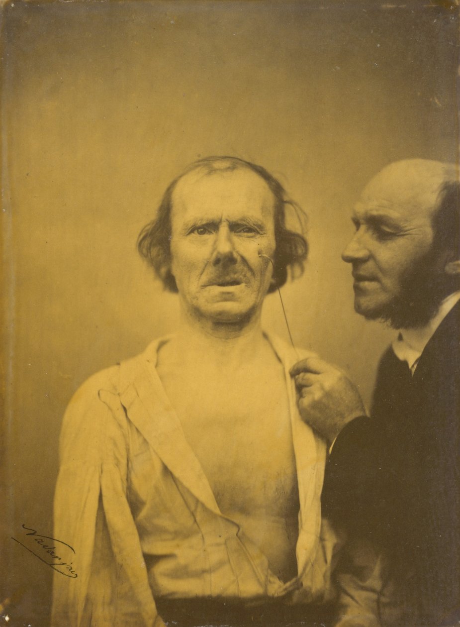 Weeping, tears of pity (left); Relaxed face (right) by Guillaume Benjamin Armand Duchenne de Boulogne