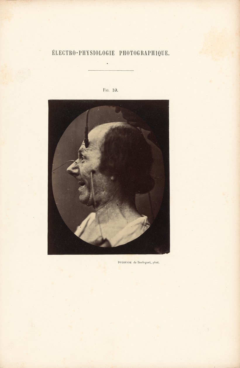 Electro-Physiology Photographic, Figure 39 by Guillaume Benjamin Duchenne