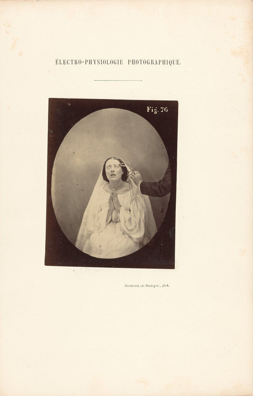 Electro-Physiology Photographic, Figure 76 by Guillaume Benjamin Duchenne