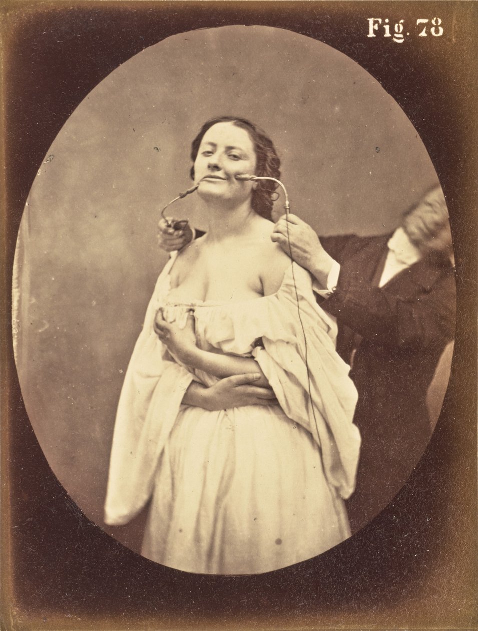 Figure 78 by Guillaume Benjamin Duchenne