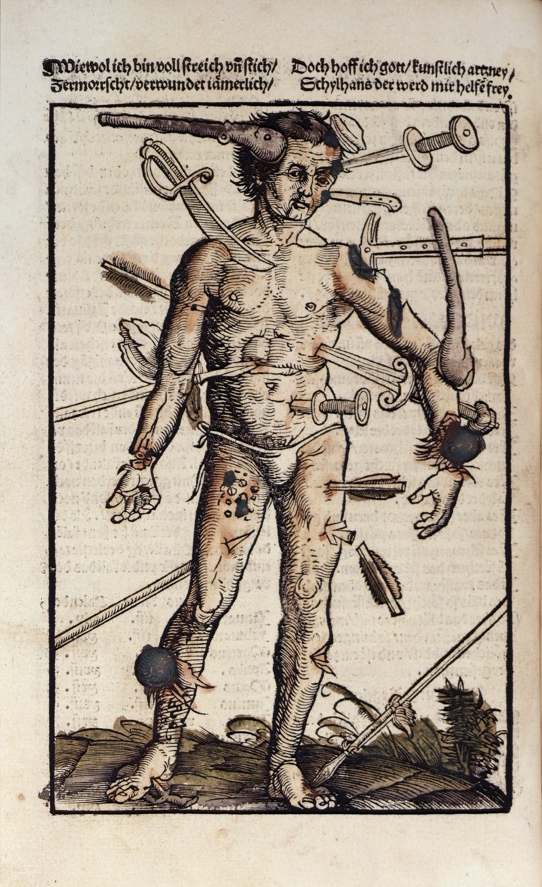 The Wound Man, from the 