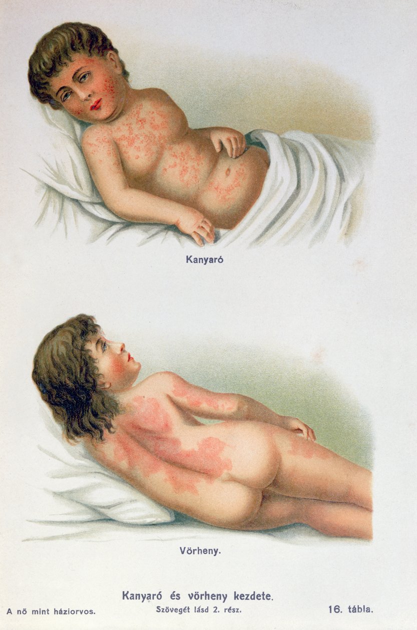 Measles and scarlet fever, from a family medical book, c.1900 by Hungarian School