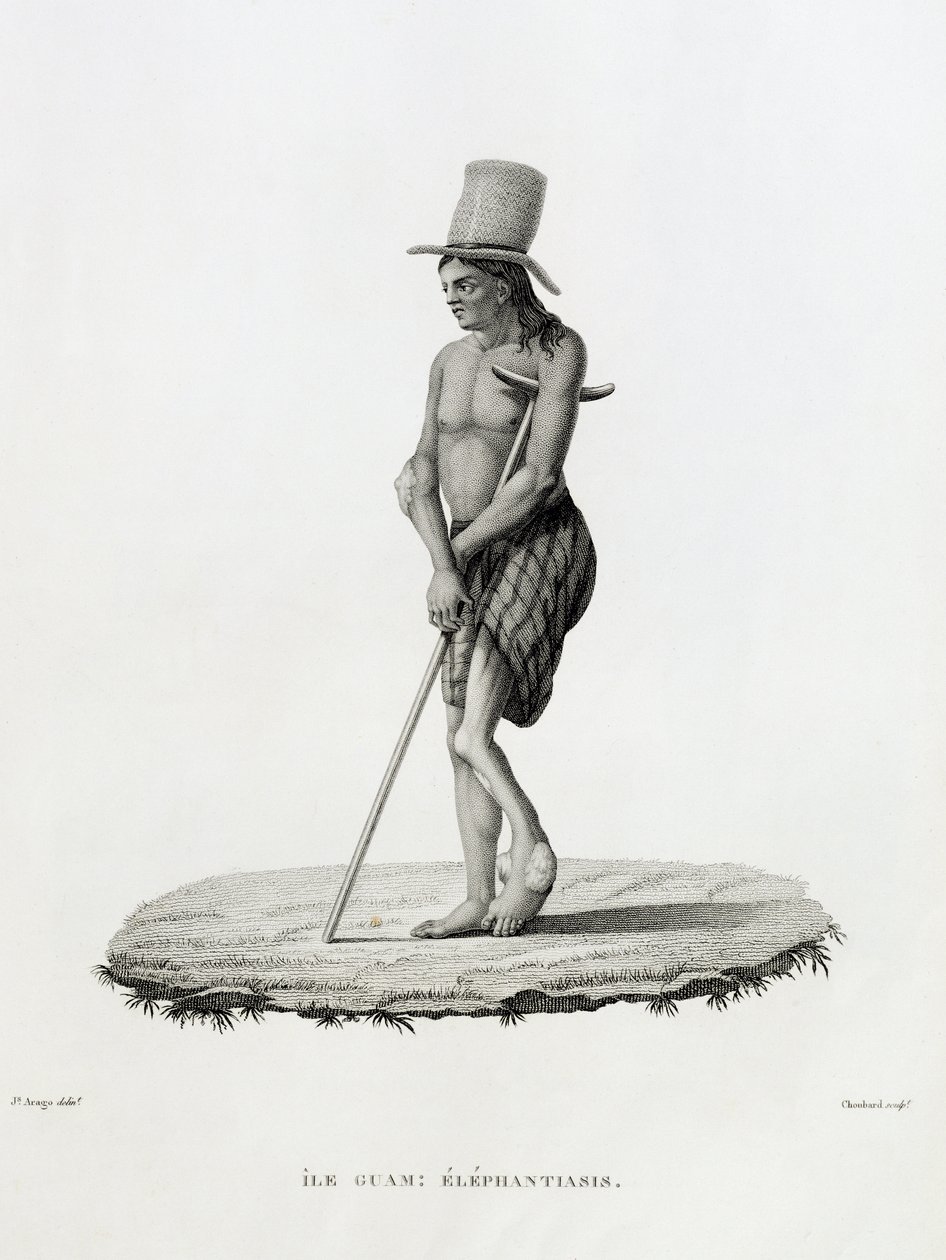 Guam: A Man with Elephantiasis, from 