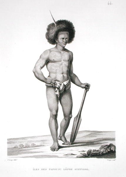 Papua Islands: Leprosy Victim, from 