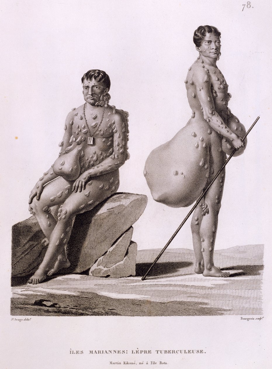 Northern Mariana Islands: Two Men Suffering from Tuberculosis, from 