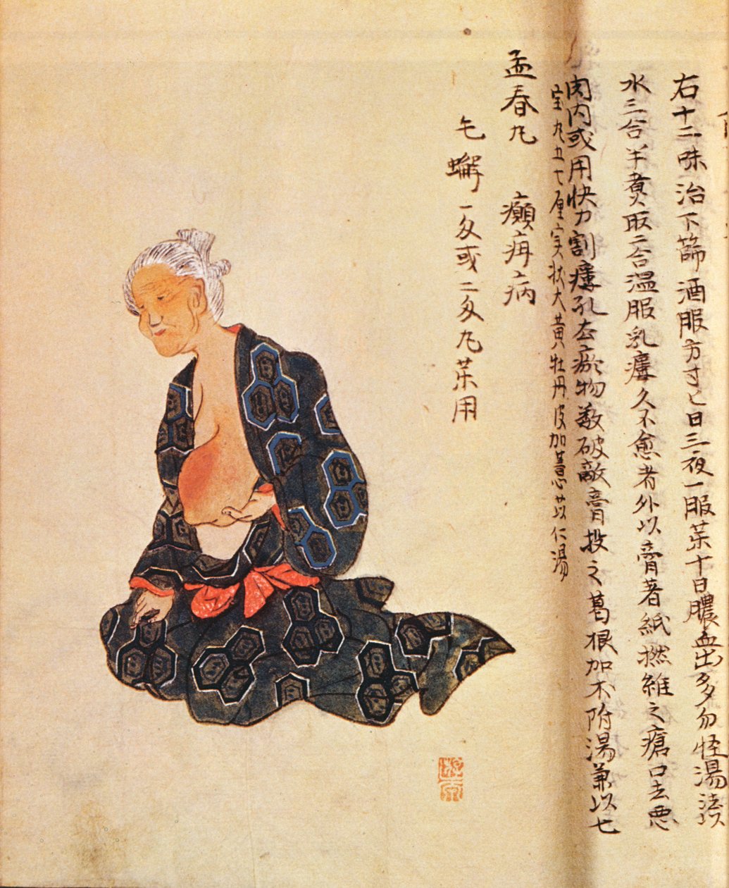 The first surgical treatment of breast cancer performed under general anaesthetic by Seishu Hanaoka in 1804 by Japanese School