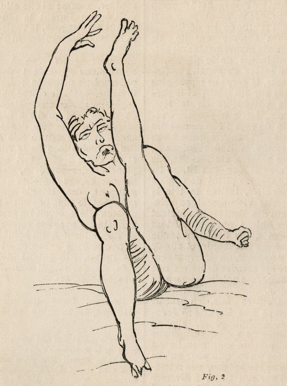 Hysterical epilepsy, attack, contortions, fig. 2 from 