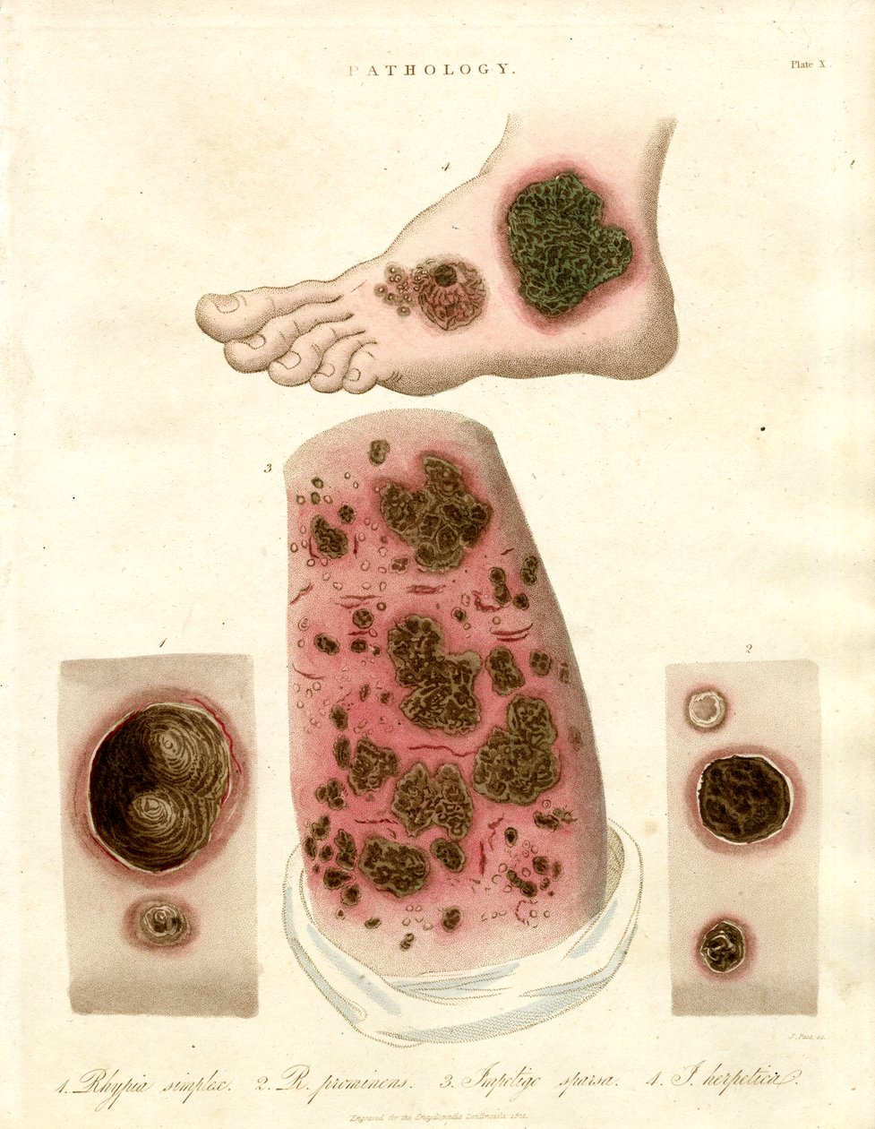 Pathological Skin Conditions - Pityria, Impetigo and Syphilis by John Pass