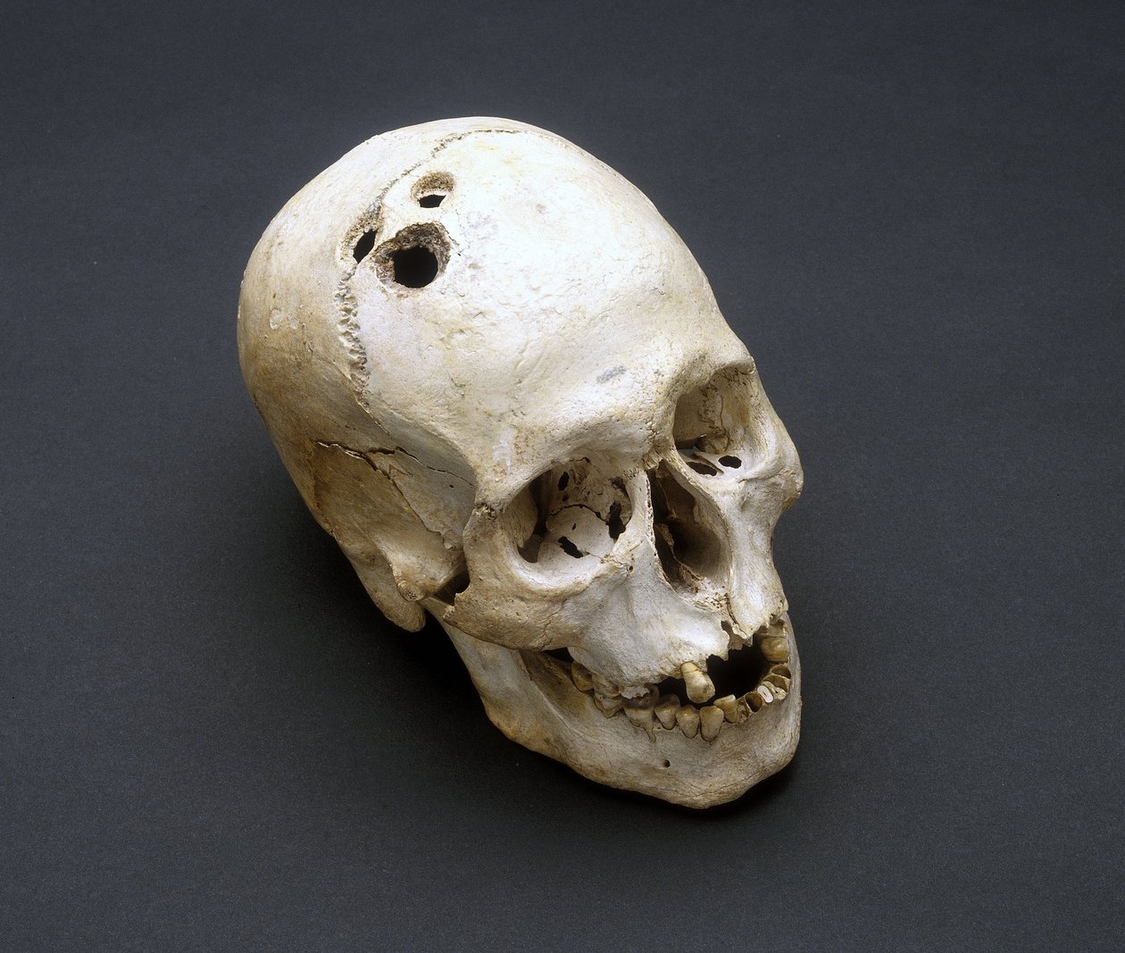 Trephination Bronze Age skull, Jericho, Palestine, 2200-2000 BC by Unbekannt Unbekannt