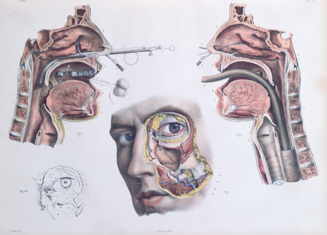 A Nasal Operation, Plate from 
