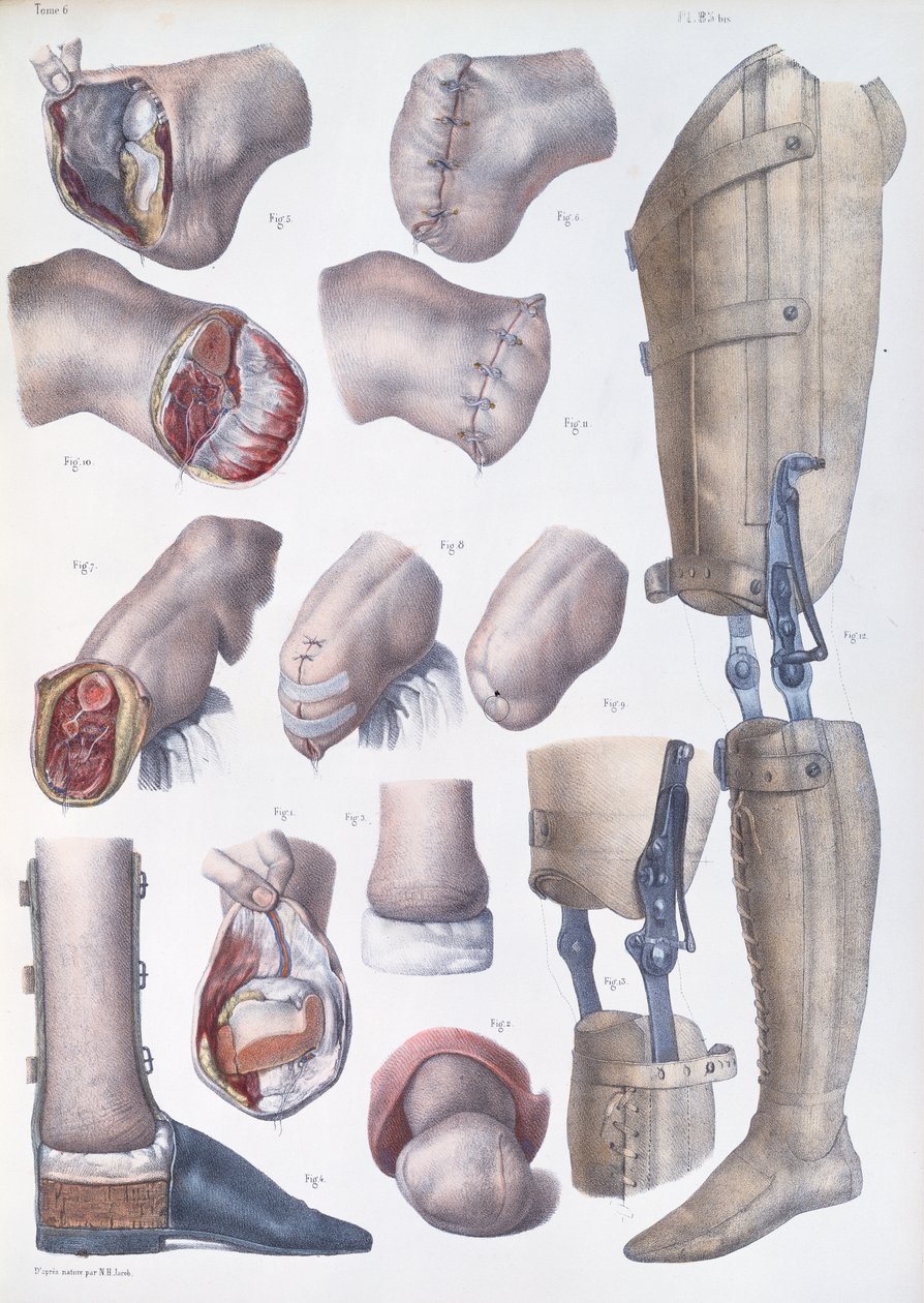 Amputations and Prosthetics, plate from 