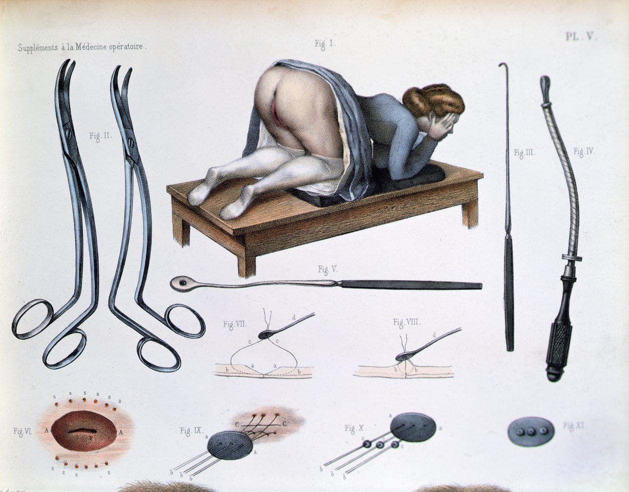An operation on a vesicovaginal fistula, plate from 