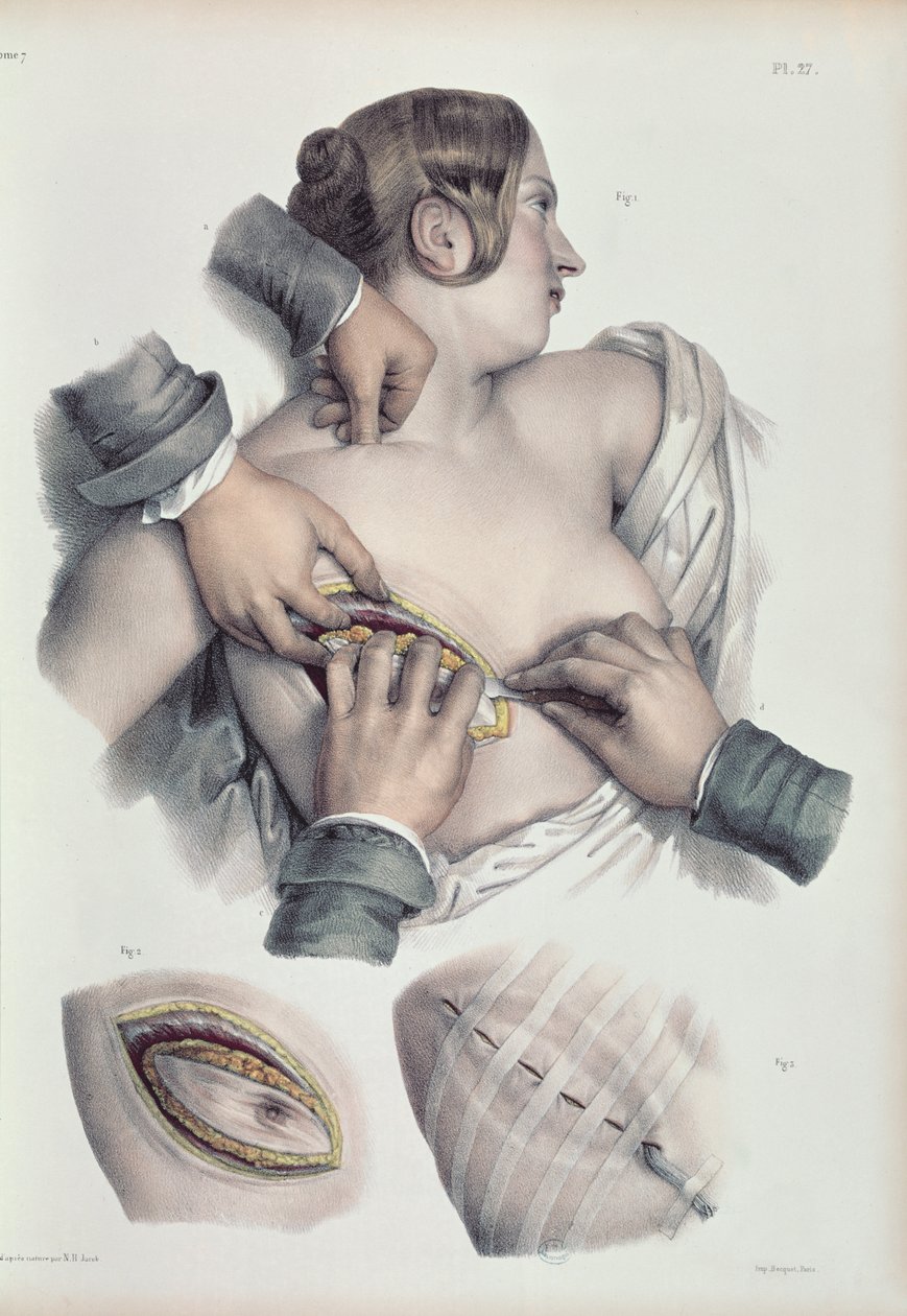 Operating on a cancerous tumour, from 