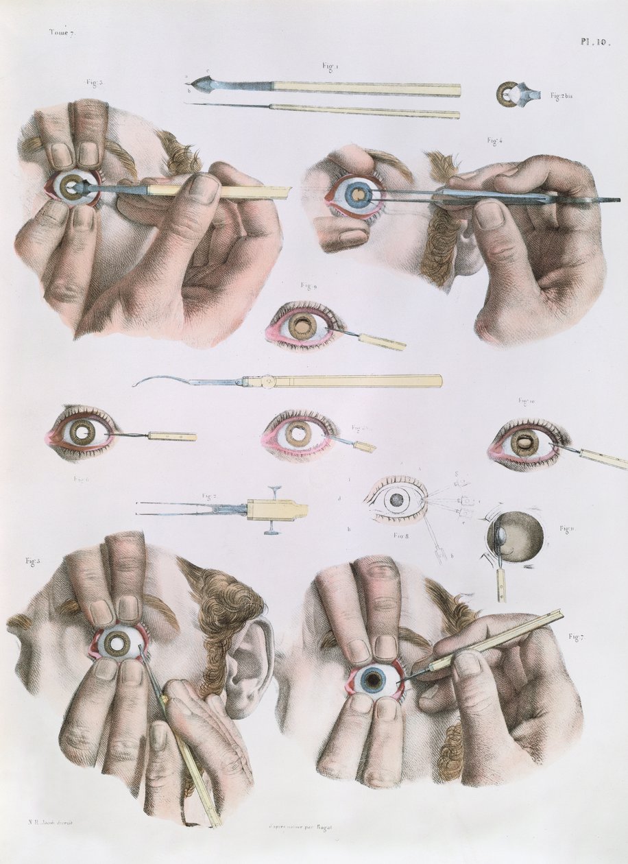 Operation on an Eye, Plate from 