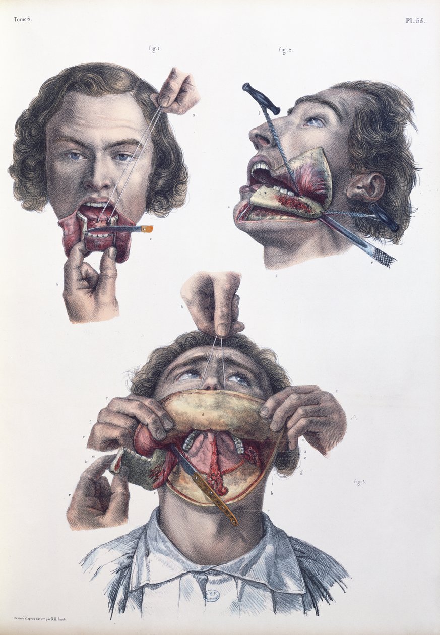 Operation on the lower jaw, plate from 
