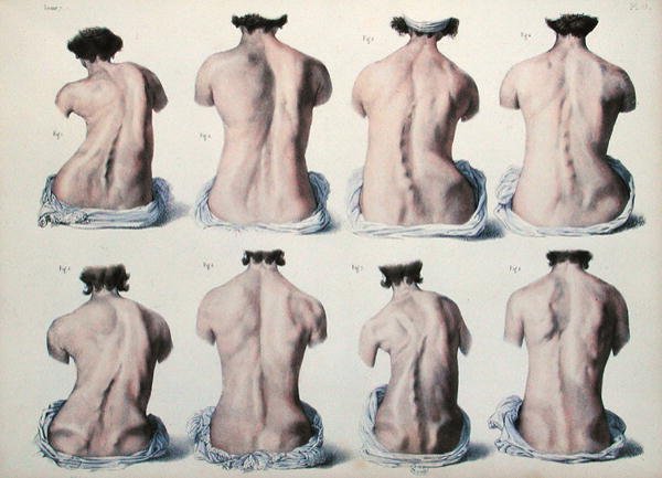 Spinal Deformities, Plate from 