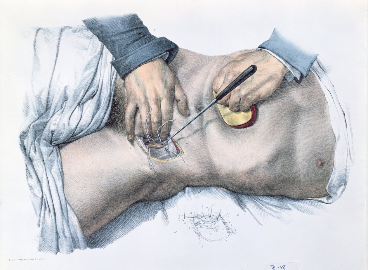 Tying up an artery, plate from 