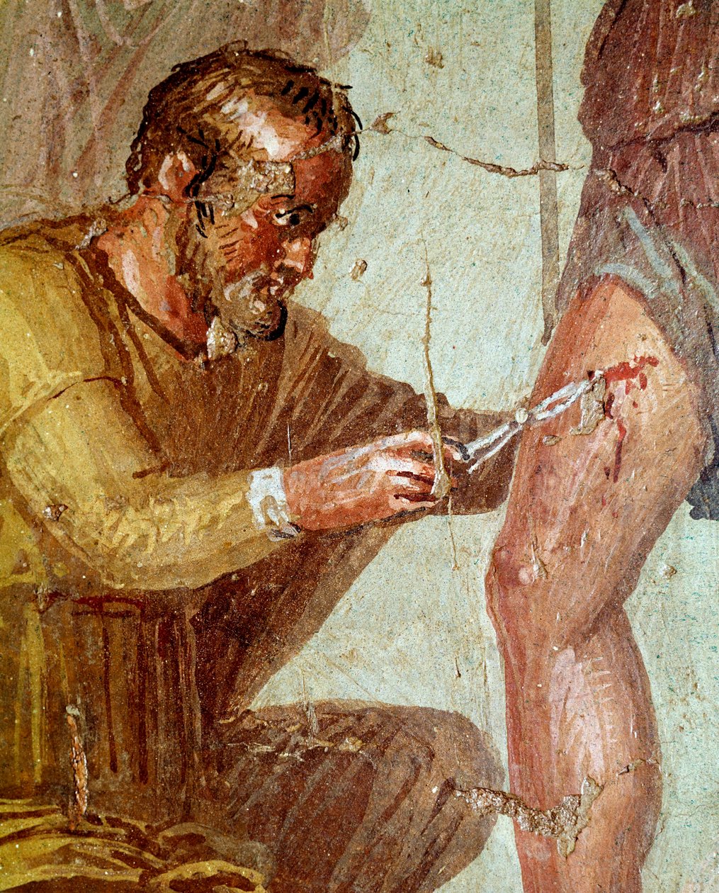 Wounded Aeneas is treated by Iapyx helped by Venus by Roman