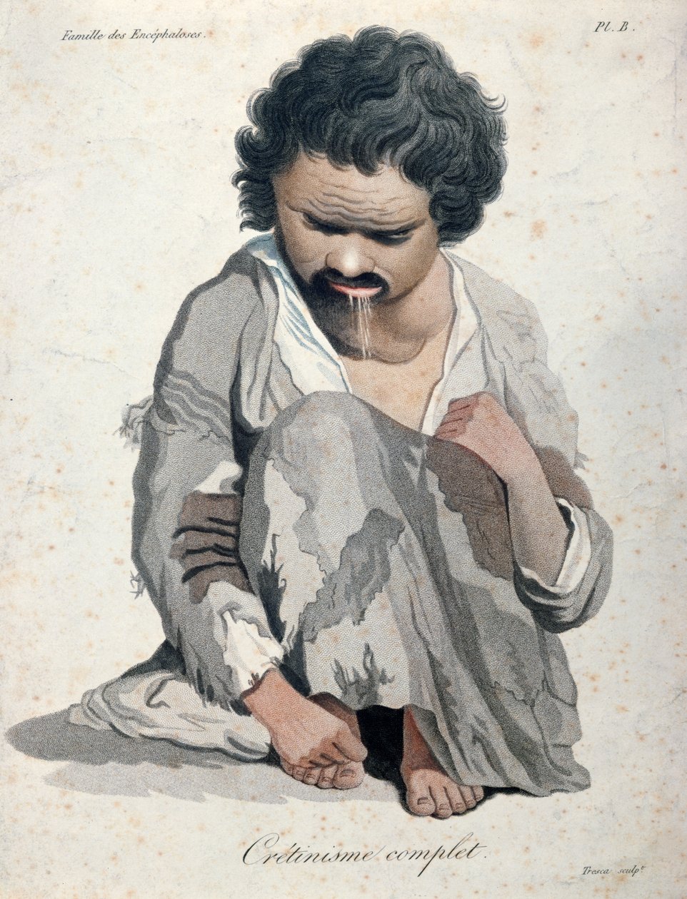 Total Cretinism (from a book by Baron Jean Louis Alibert) by Salvadore Tresca